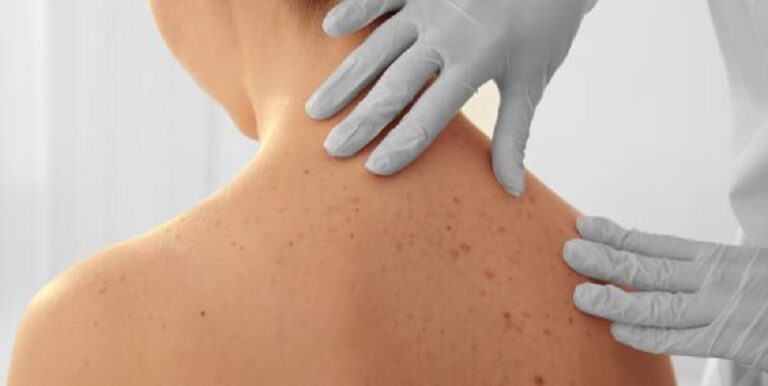 نمط جلدي يوحي لمشكلة صحية مميتة؟