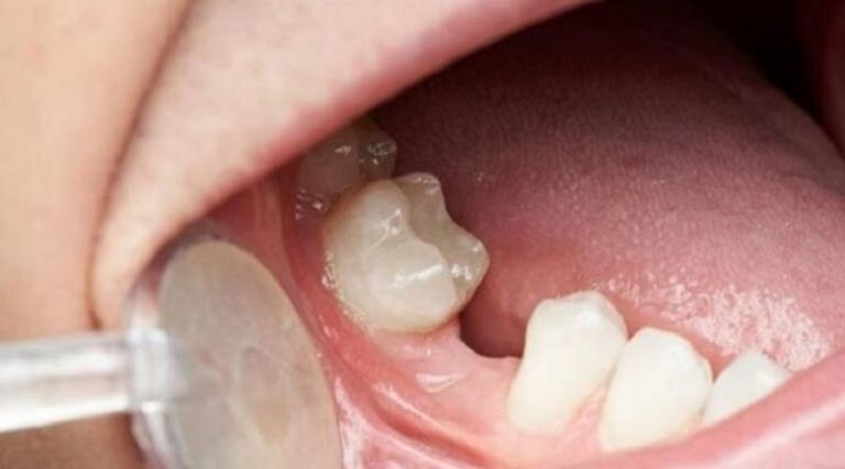 ارتباط بين فقدان الأسنان وزيادة خطر السمنة!