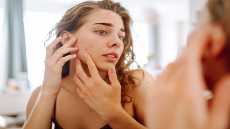 فاكهة تساعد في مقاومة حب الشباب؟