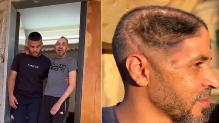 جريح فلسطيني فقد جزءاً من جمجمته! (فيديو)