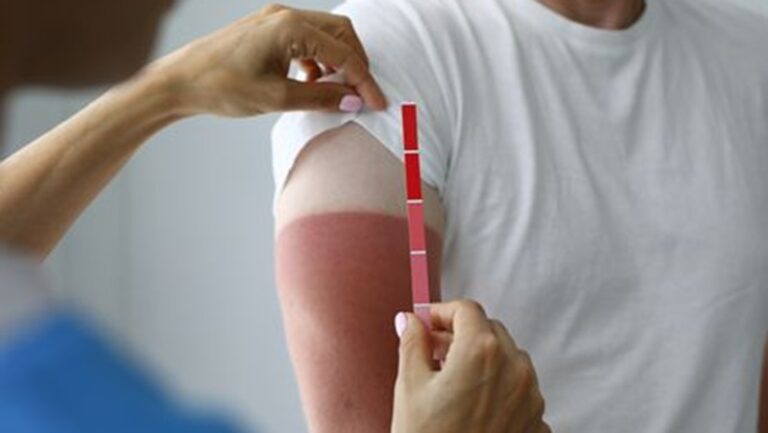 الإسعافات الأولية الضرورية عند التعرض لحروق الشمس