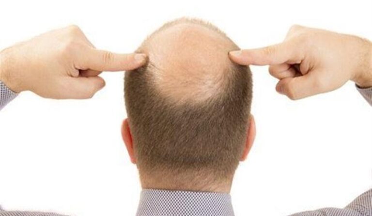 السكر علاج طبيعي للصلع؟