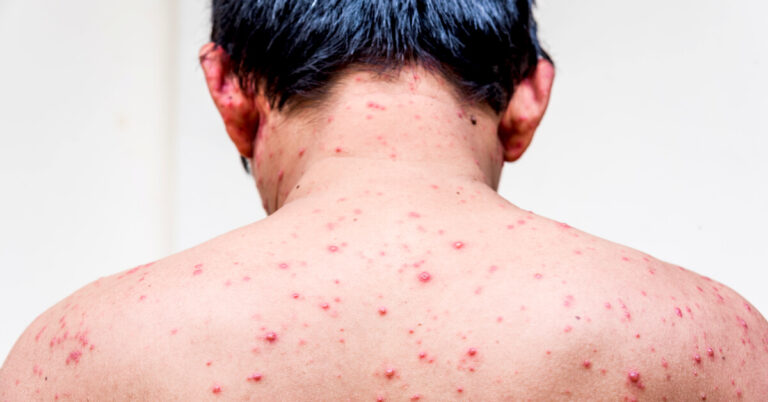 إرتفاع إصابات “الإيدز” في لبنان