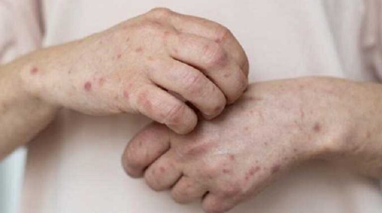 “الصحة” تذكّر بكيفية الوقاية من مرض جدري القرود