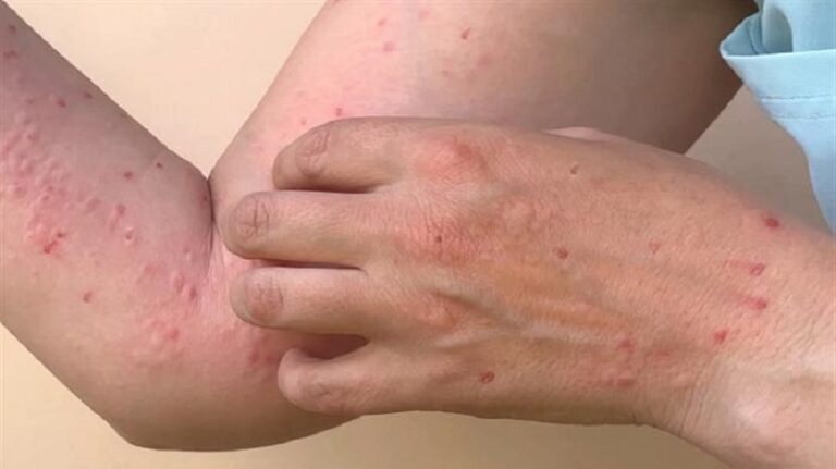 ولاية أوسترالية أعلنت ارتفاع إصابات جدري القردة