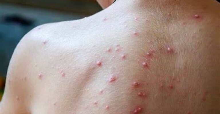 أول إصابة بالسلالة الجديدة من جدري القردة في السويد