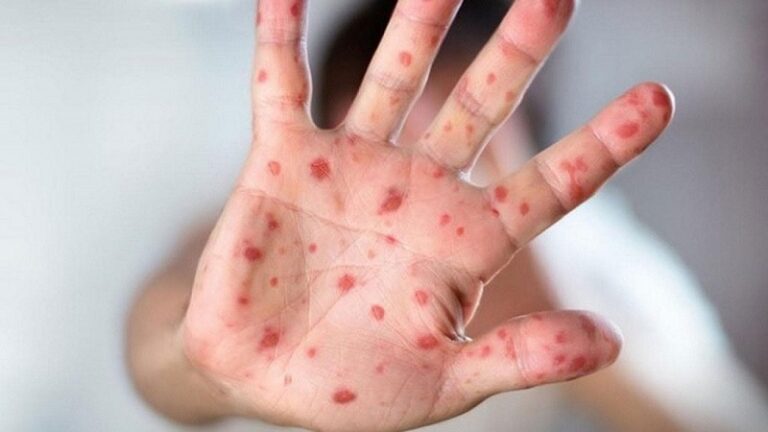 17 ألف إصابة بجدري القردة في دول الإتحاد الأفريقي!