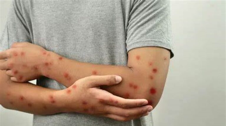 21 إصابة مؤكدة بجدري القردة في الكونغو-برازافيل