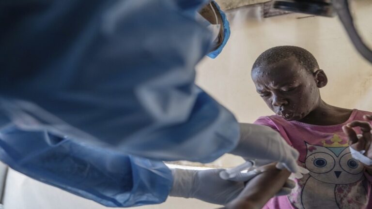 الكونغو  تسجل أكثر من 1000 إصابة بجدري القرود في أسبوع