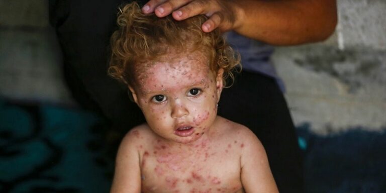 غزة تحت الحصار الطبي.. وأكثر من 900 حالة وفاة