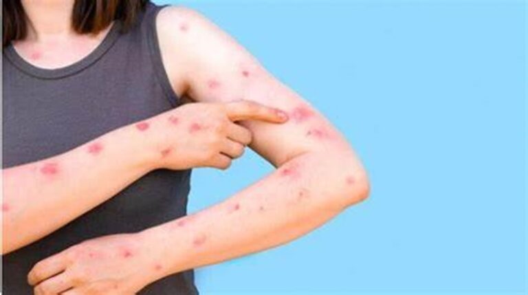 تفشي “جدري القردة” في أفريقيا ناجم عن الإهمال؟