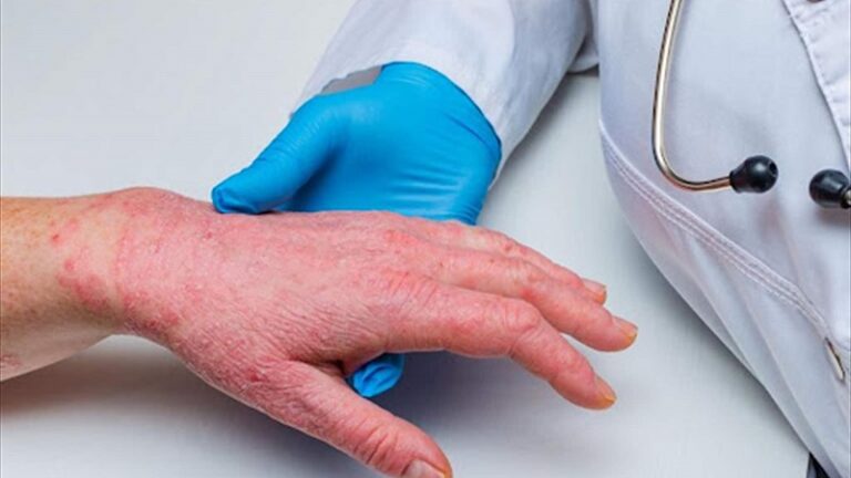 “الصحة”: لا حالات جديدة بجدري القرود من شهر آذار