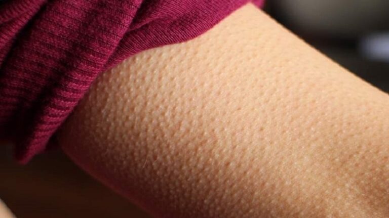 القشعريرة في الأطراف تشير إلى مرض التصلب المتعدد