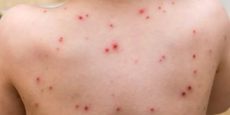 “الصحة” العالمية تعقد إجتماعاً بسبب “جدري القردة”