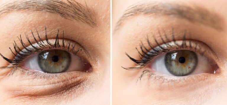 أمراض تدل عليها الانتفاخات تحت العين