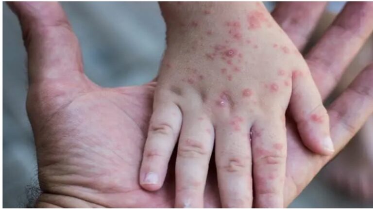 تسجيل أول إصابة بجدري القردة في فرنسا