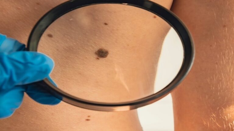 5 علامات لتشخيص الشامة السرطانية