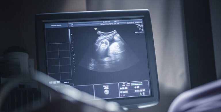 ولادة طفل يحمل جنينين!