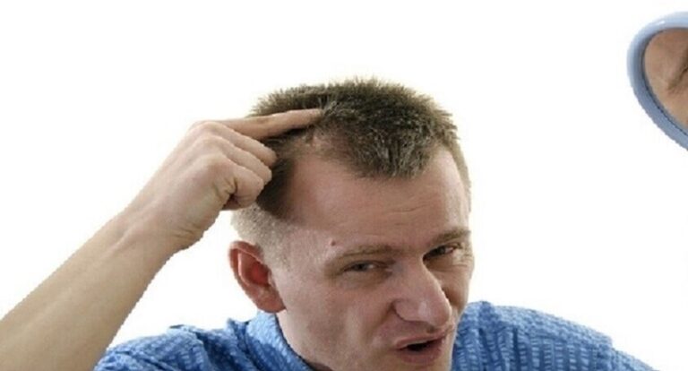 التوتر يسبب الصلع!