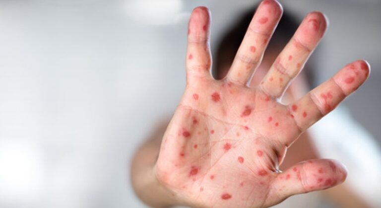 الحمى القلاعية تُقلق البقاع: حالات مشتبه بها.. واللقاح مفقود!