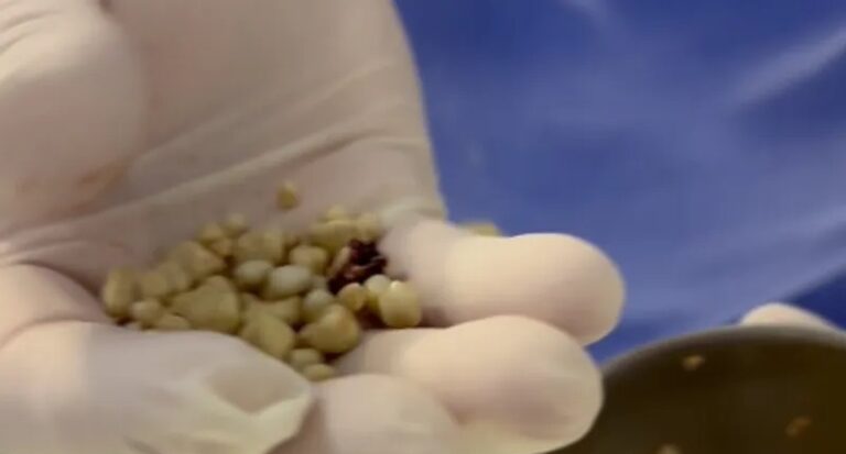 استخراج 30 حصوة من كلية رجل