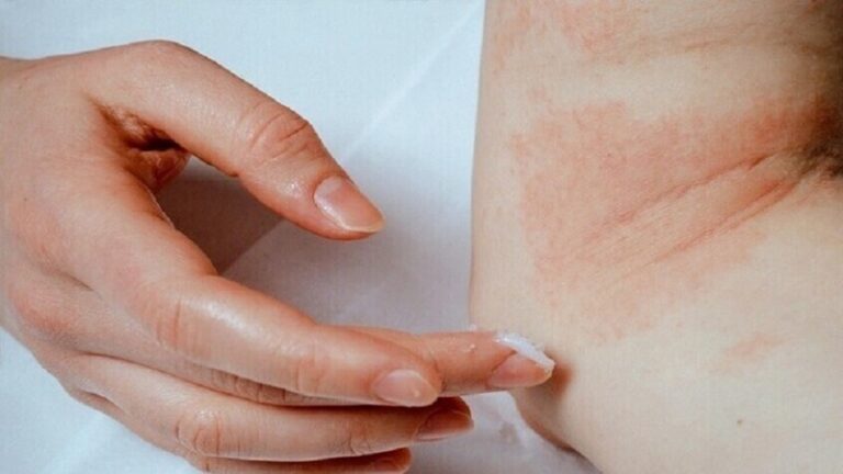 أخطر مسببات الحساسية!