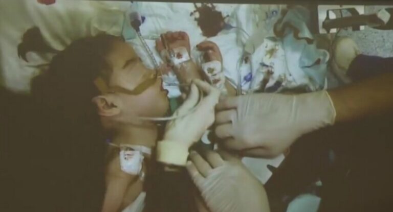 نجاح عملية فصل التوأم السوري سيلين وإيلين في الرياض (فيديو)