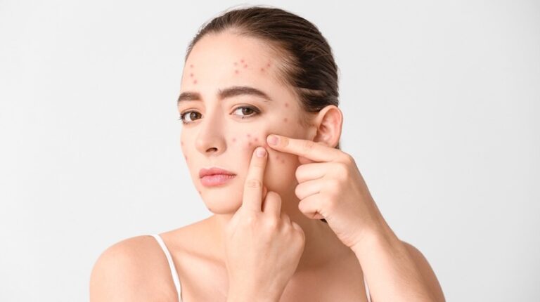 الشمس تؤثر على حب الشباب؟