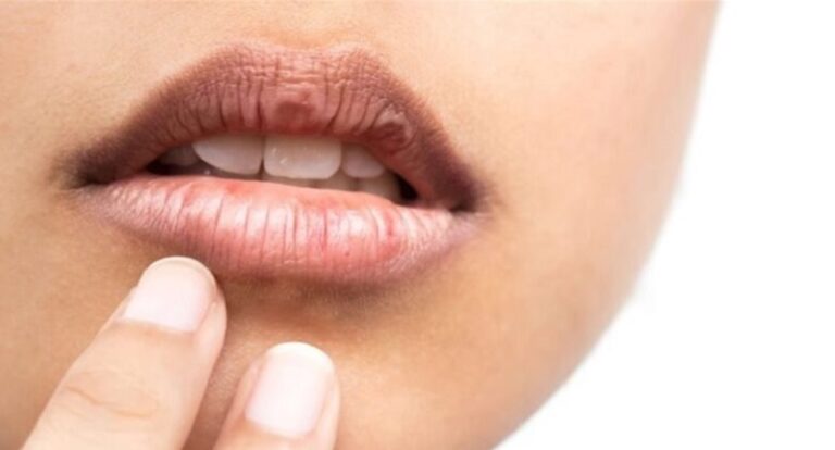 علامات مبكرة لسرطان الفم!