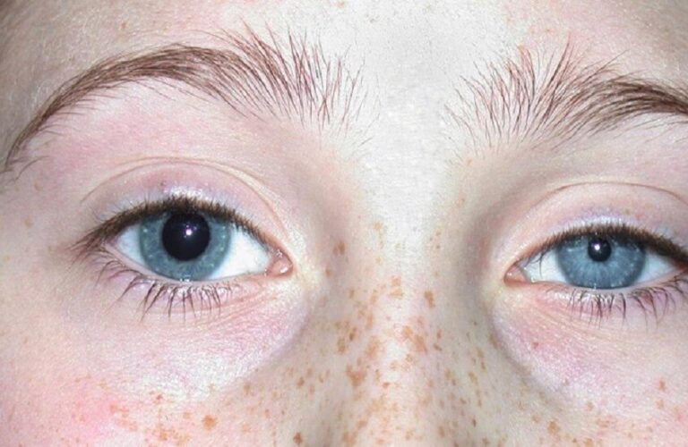 تباين حدقتي العين بين الطبيعي والمرضي.. وأثره على إدراك الضوء