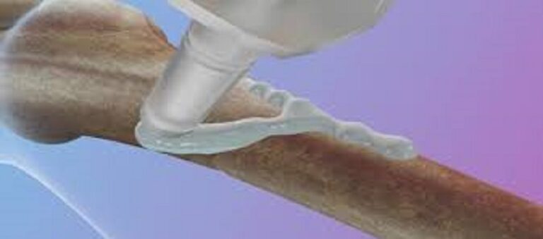 غراء طبي صيني يصلح الكسور في 3 دقائق فقط؟