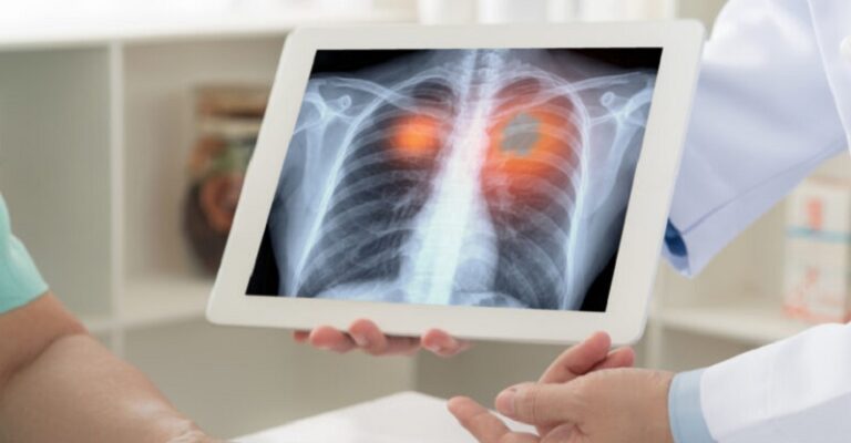 طريقة جديدة لتشخيص مرض السل