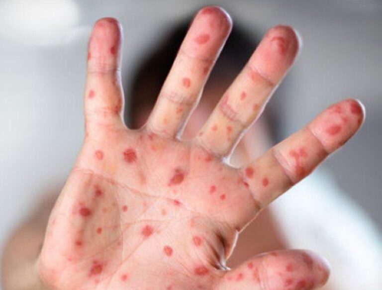 وباء يتفشى في كيان الإحتلال بوتيرة متسارعة!