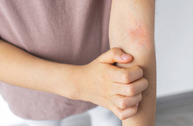 أمراض جلدية تتفاقم في الخريف والشتاء