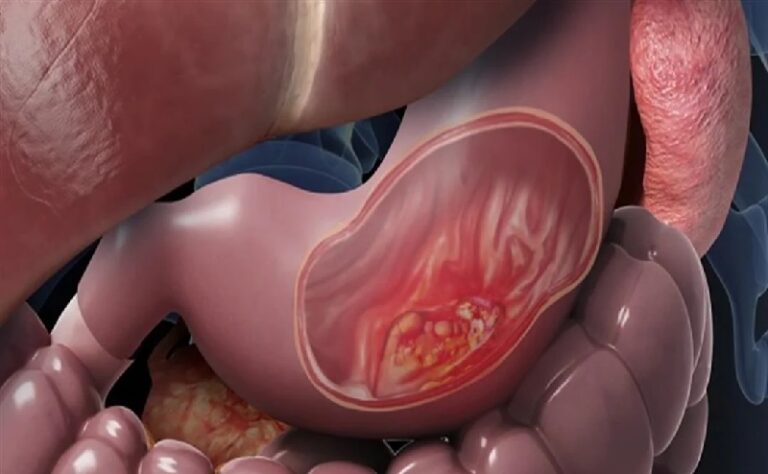 5 علامات مبكرة لسرطان المعدة