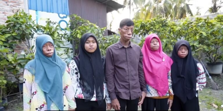 عائلة إندونيسية تتحول وجوهها إلى “سحالي”! (فيديو)